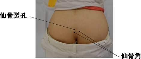 図：仙骨ブロックの穿刺部分