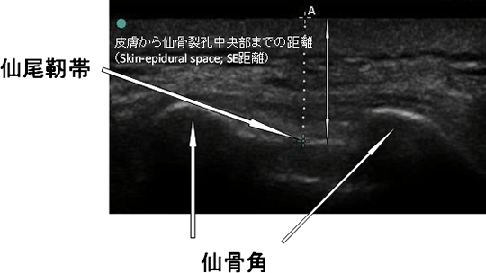 図：仙骨裂孔の超音波検査画像